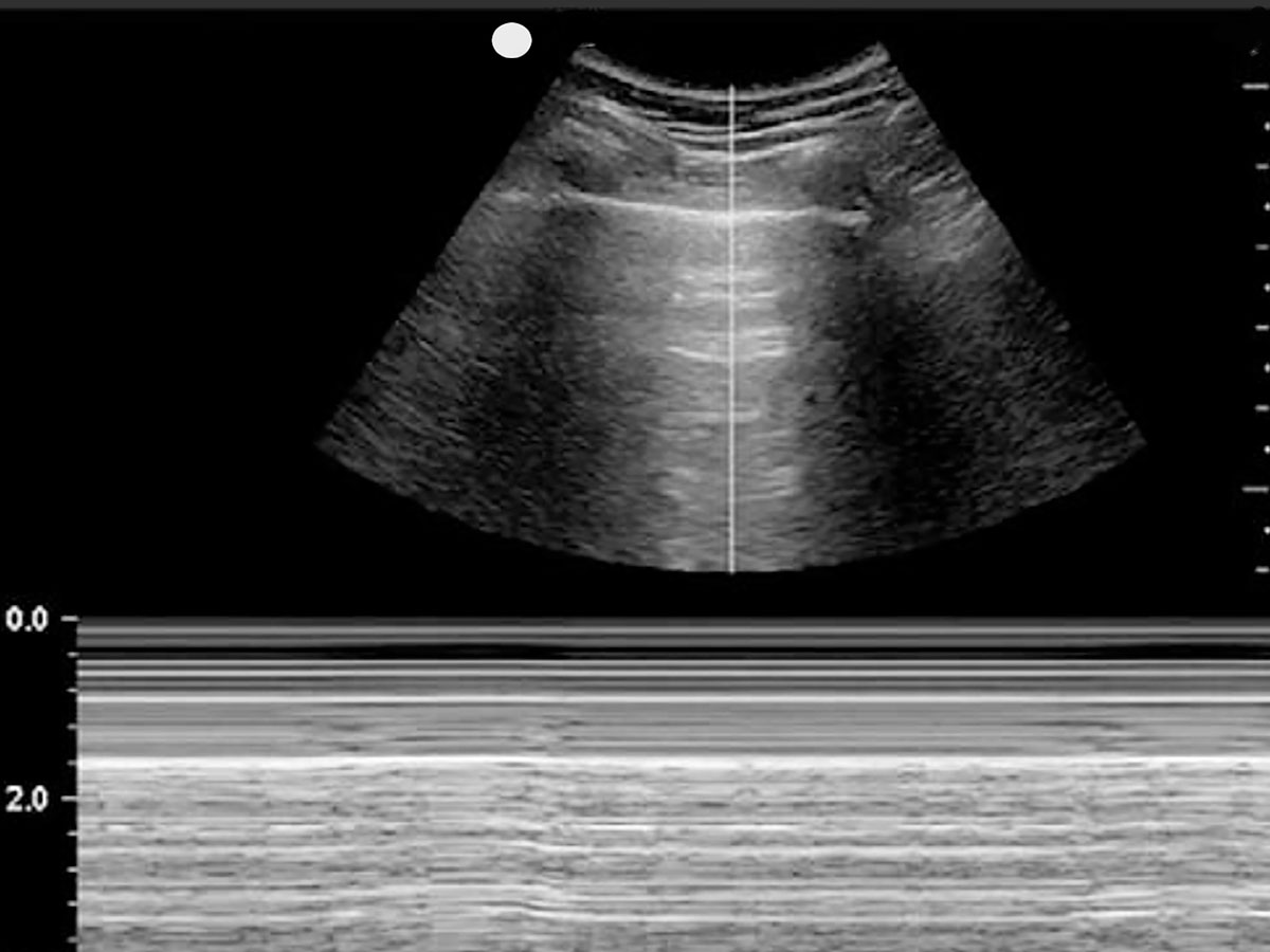 Lung Sonogram